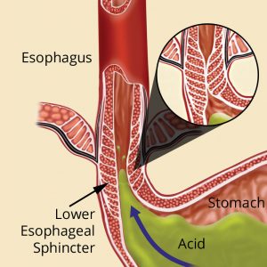 Reflux is caused by a weak muscle called the lower esophageal sphincter (LES) that allows acid and bile to flow back from the stomach into the esophagus, creating pain and often causing damage to the lining of the esophagus.