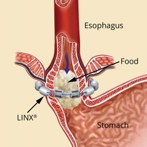When you swallow, LINX opens temporarily to allow food and liquid to pass into the stomach.